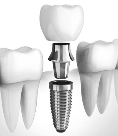 Zubni implanti